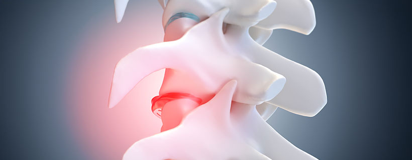 patient needing Degenerative Disc Disease in need of Spinal Decompression Therapy in Raleigh