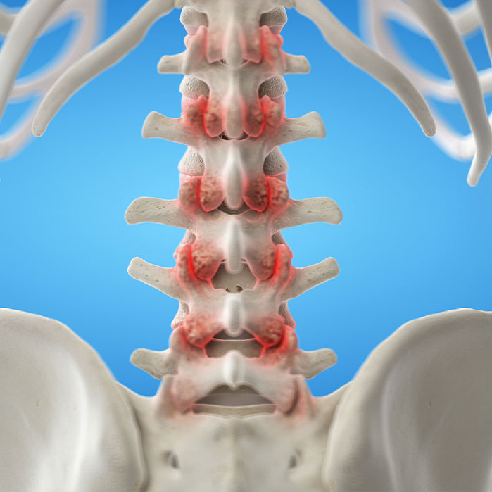 facet Joint Syndrome treatment in Raleigh