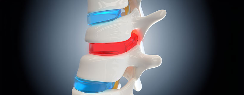 patient needing herniated disc in need of Spinal Decompression Therapy in Raleigh