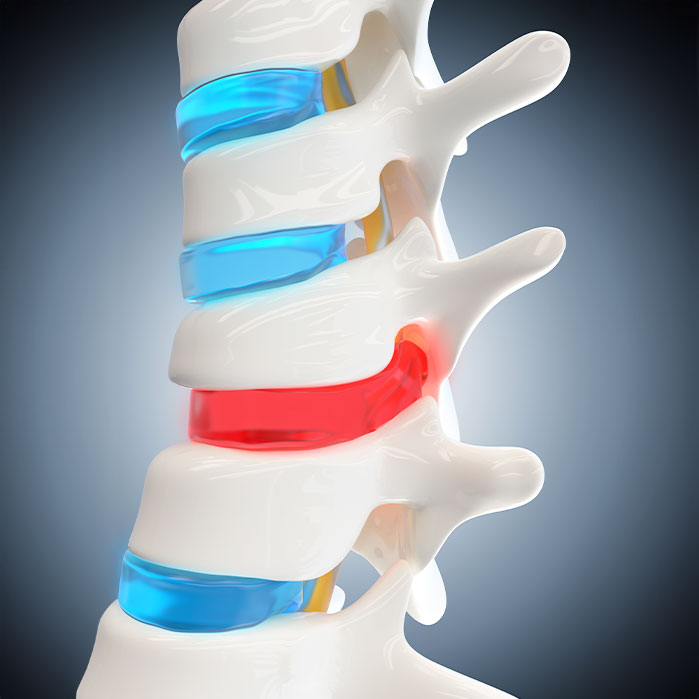 herniated Disc treatment in Raleigh