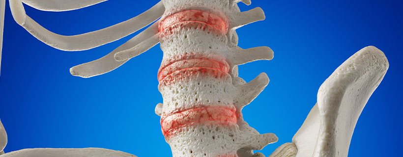 patient needing osteoarthritis in need of Spinal Decompression Therapy in Raleigh