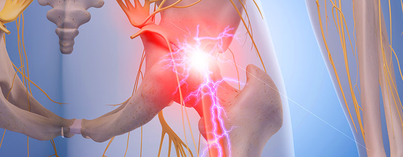 patient needing sciatica in need of Spinal Decompression Therapy in Raleigh