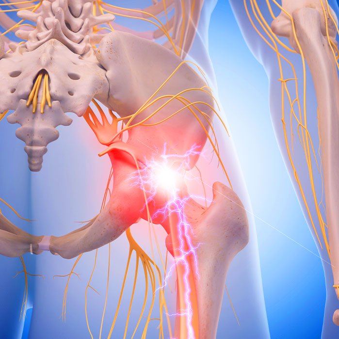 sciatica treatment in Raleigh