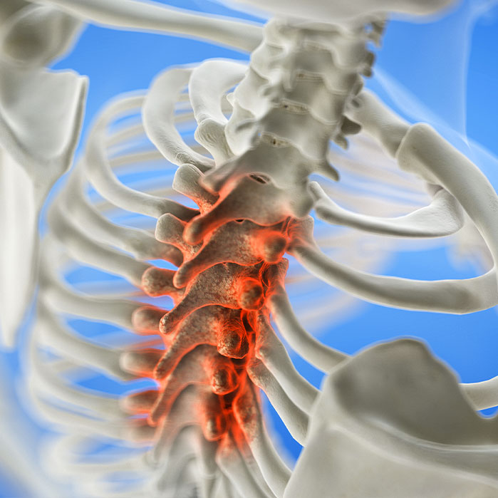 spinal Stenosis treatment in Raleigh