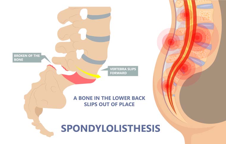 patient needing Spondylolisthesis in need of Spinal Decompression Therapy in Raleigh