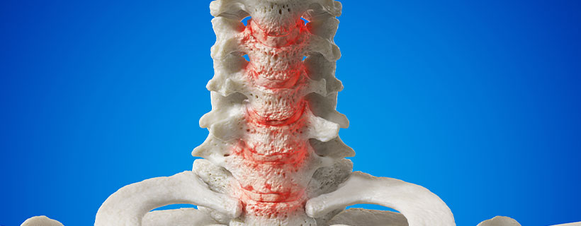 patient needing Spondylosis in need of Spinal Decompression Therapy in Raleigh