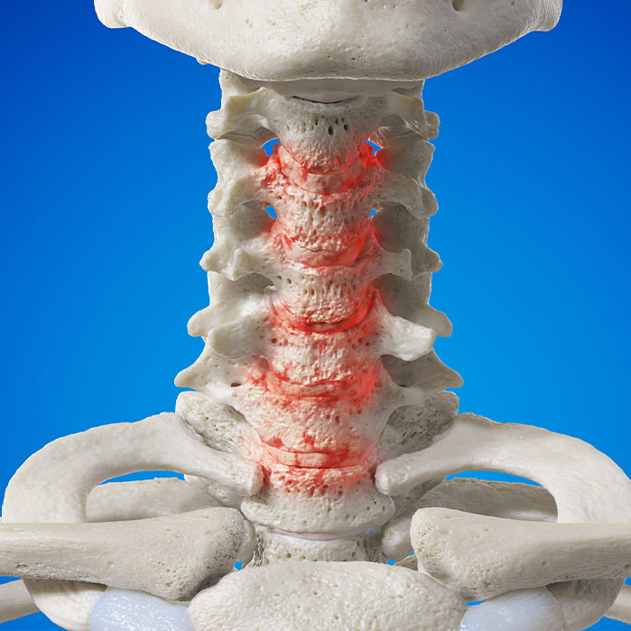 spondylosis treatment in Raleigh